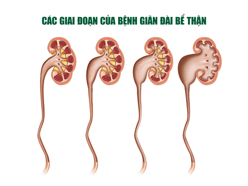 Bệnh giãn đài bể thận là gì?