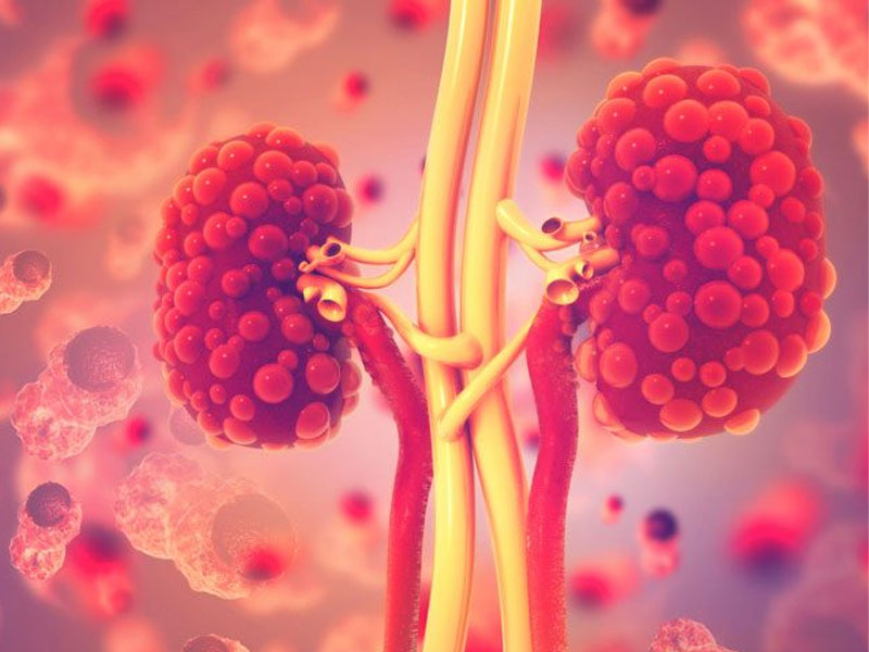 Thận đa nang là căn bệnh nguy hiểm làm hỏng thận nếu không điều trị 