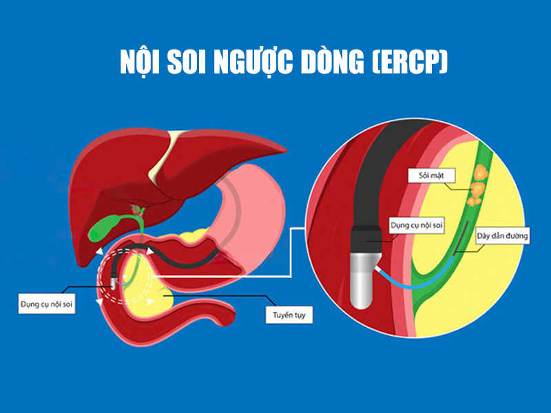  Cách điều trị sỏi tụy bằng phương pháp nội soi ngược dòng (ERCP)