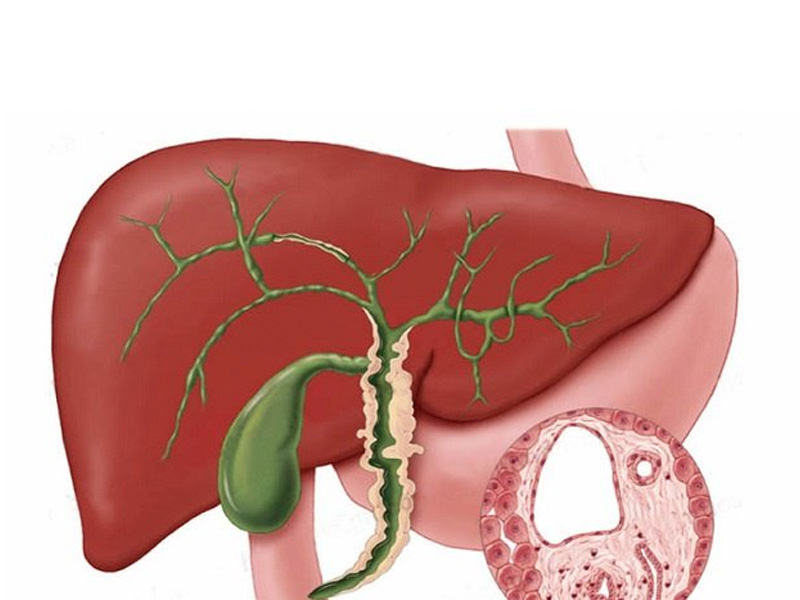 Viêm đường mật trong gan gây xuất huyết đường mật