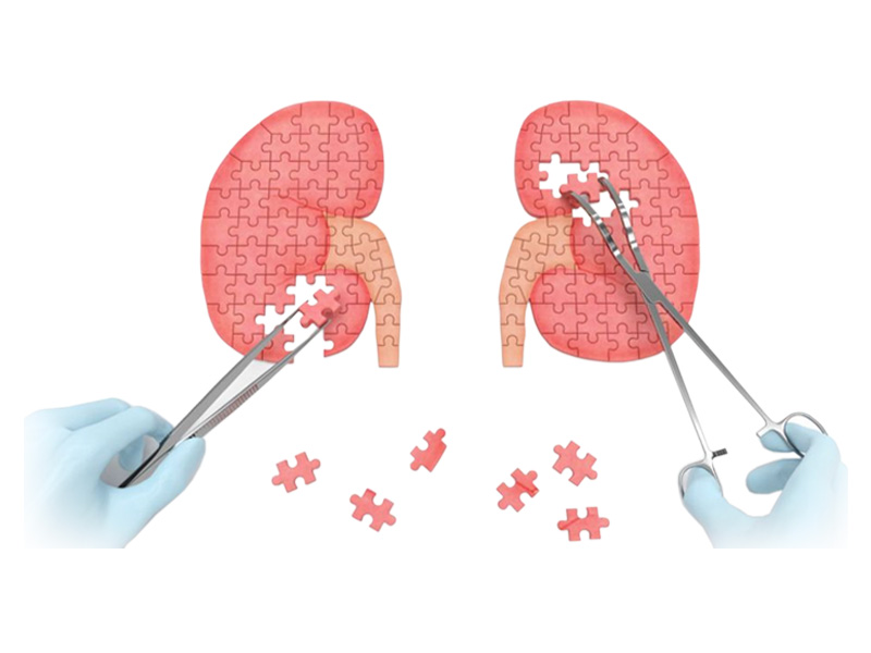 Bệnh thận đa nang có nên phẫu thuật không ạ?