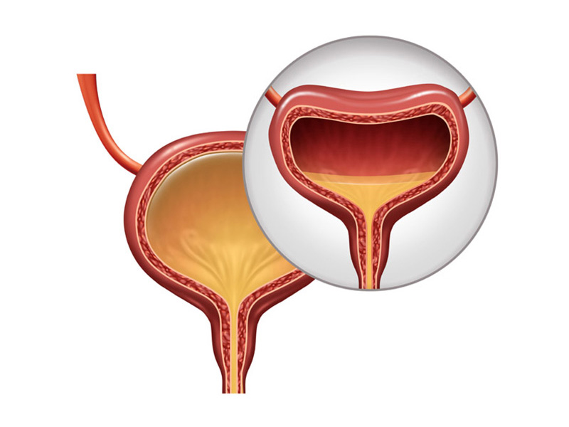 Sỏi bùn bàng quang là gì?