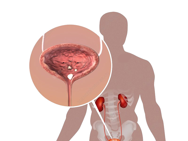 Sỏi bàng quang càng lớn càng làm suy giảm chức năng thận
