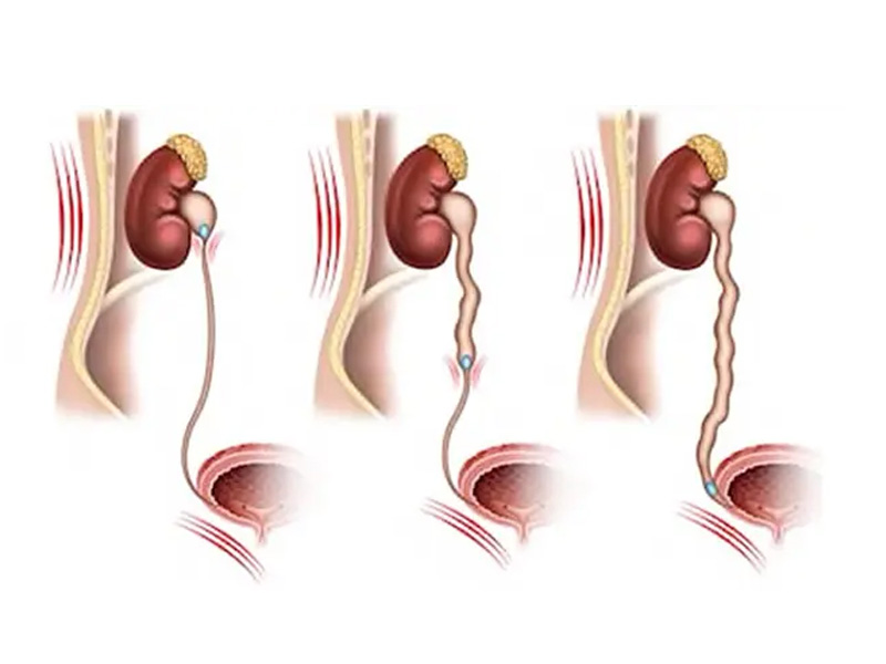 Sỏi niệu quản 1/3 giữa chỉ vị trí sỏi nằm ở giữa đường niệu quản nối từ thận xuống bàng quang