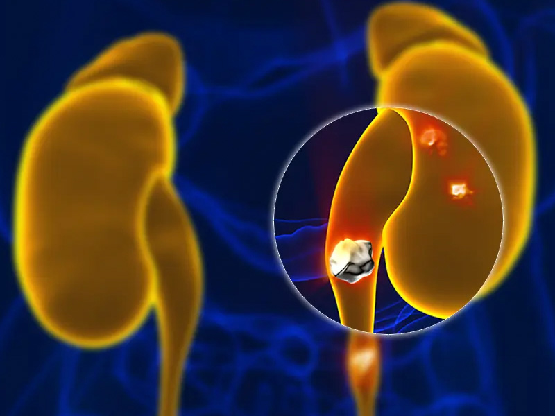 Sỏi thận là một trong những nguyên nhân chủ yếu hình thành nên sỏi niệu quản đoạn giữa 1/3