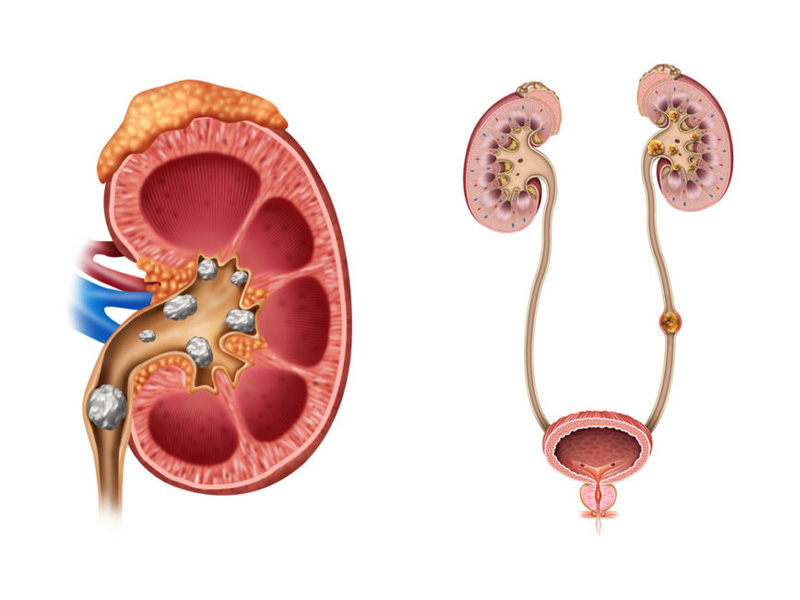 Đau tức vùng hông, đau lan xuống vùng xương chậu và hai đùi là triệu chứng thường gặp của sỏi niệu quản