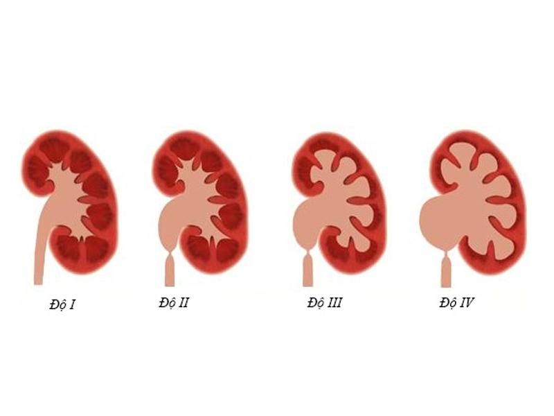Thận ứ nước là tiền đề hình thành thận ứ mủ, bệnh có ảnh hưởng xấu đến chức năng thận