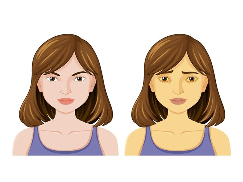 Do sắc tố từ bilirubin khiến da, mắt có màu vàng