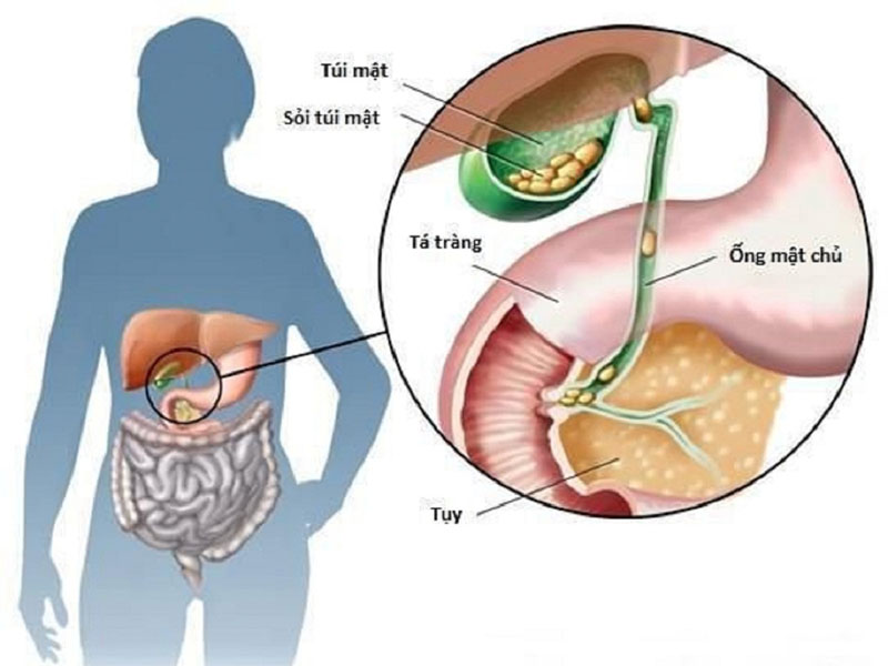 Trẻ em bị vàng da tắc mật thường do nhiễm giun sán hoặc bị u nang