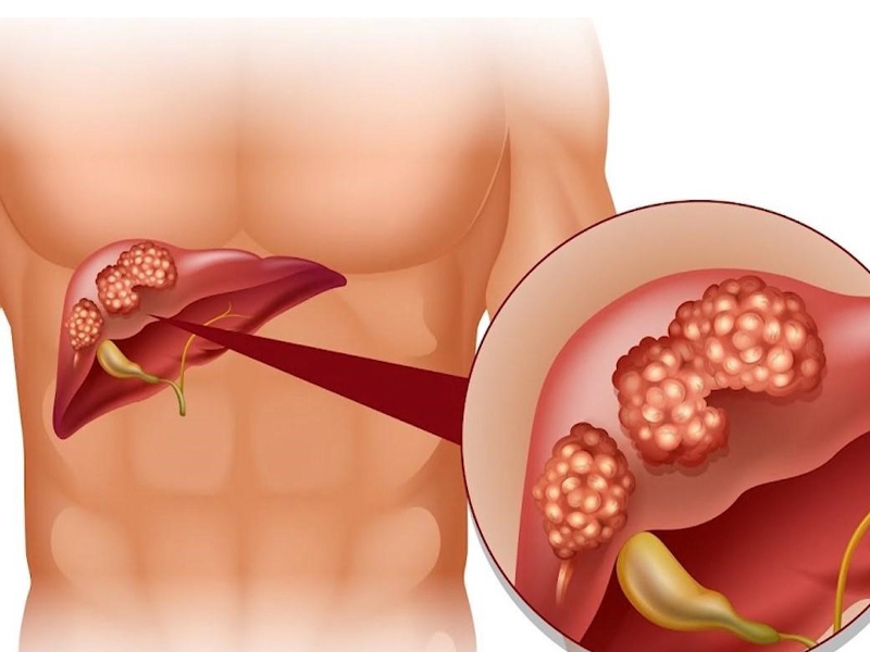 Viêm gan do nhiễm trùng là căn bệnh về gan rất phổ biến và nguy hiểm