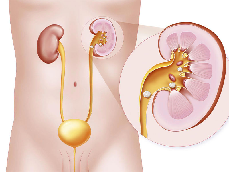 Sỏi thận thuộc bệnh thận do kết quả của các tinh thể rắn tạo nên