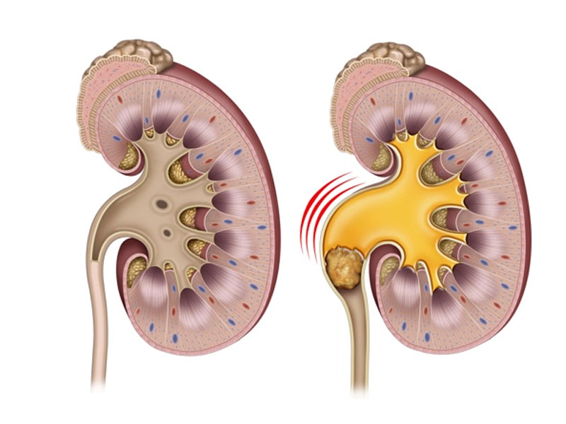 lưu ý về sỏi thận 