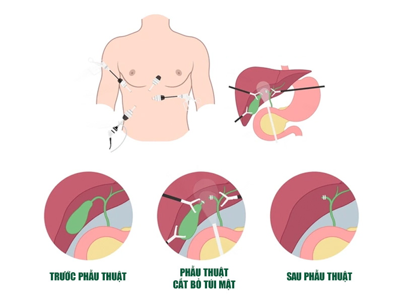 Cắt túi mật sẽ ảnh hưởng đến quá trình tiêu hoá ở giai đoạn đầu