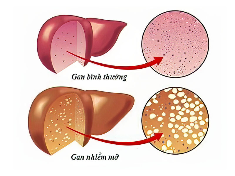 Gan nhiễm mỡ là sự thay đổi quá lớn lượng mỡ thừa được cho phép tồn tại trong cơ quan này