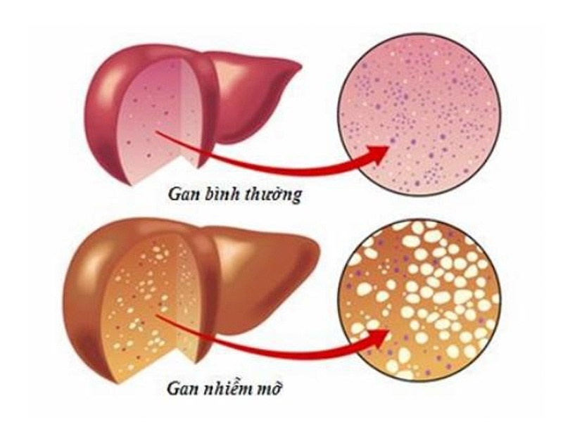 Gan nhiễm mỡ làm thay đổi cấu trúc và hình dạng của gan