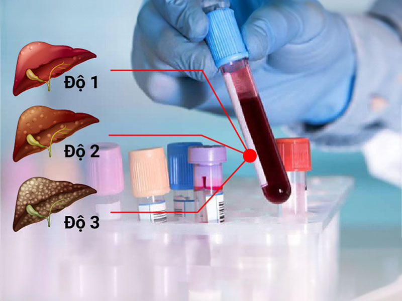Bệnh gan nhiễm mỡ độ 1 thường không có triệu chứng mà chỉ làm xét nghiệm gan mới phát hiện 