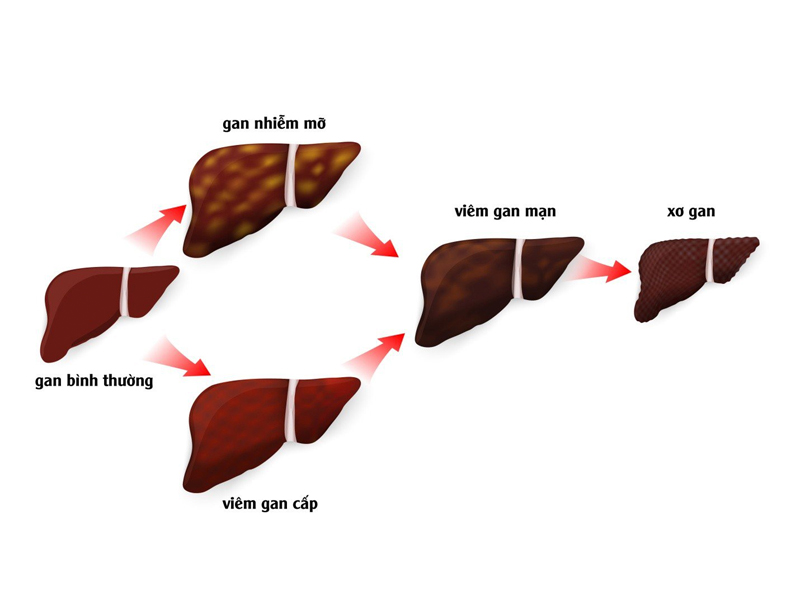 Gan nhiễm mỡ độ 2 rất dễ dẫn đến biến chứng viêm gan 