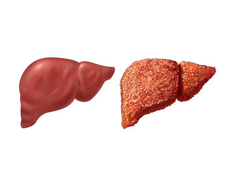 Gan nhiễm mỡ độ 3 gây biến chứng xơ gan 