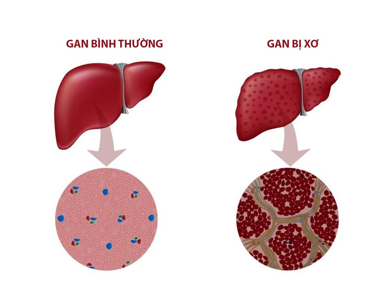 Gan nhiễm mỡ ở trẻ em dễ dẫn đến xơ gan