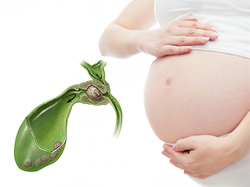 Phụ nữ mang thai bị sỏi mật rất nguy hiểm