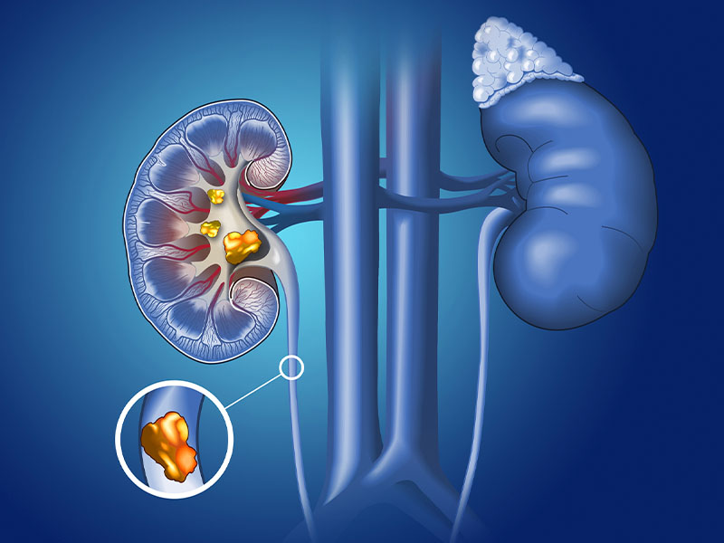 Sỏi niệu quản là gì?