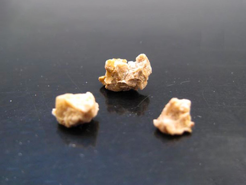  Sỏi thận 6mm có lớn không?