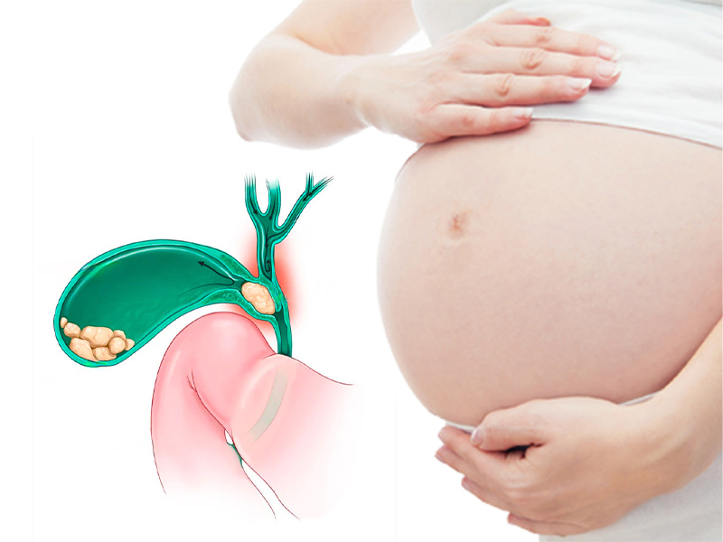 Triệu chứng của sỏi mật ở phụ nữ mang thai