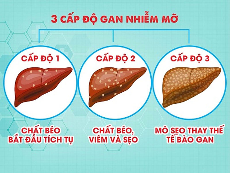Gan nhiễm mỡ độ 1 là cấp độ nhẹ của bệnh gan nhiễm mỡ