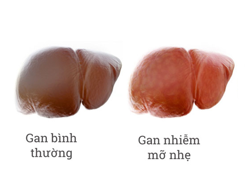 Bệnh gan nhiễm mỡ nhẹ thường không có triệu chứng