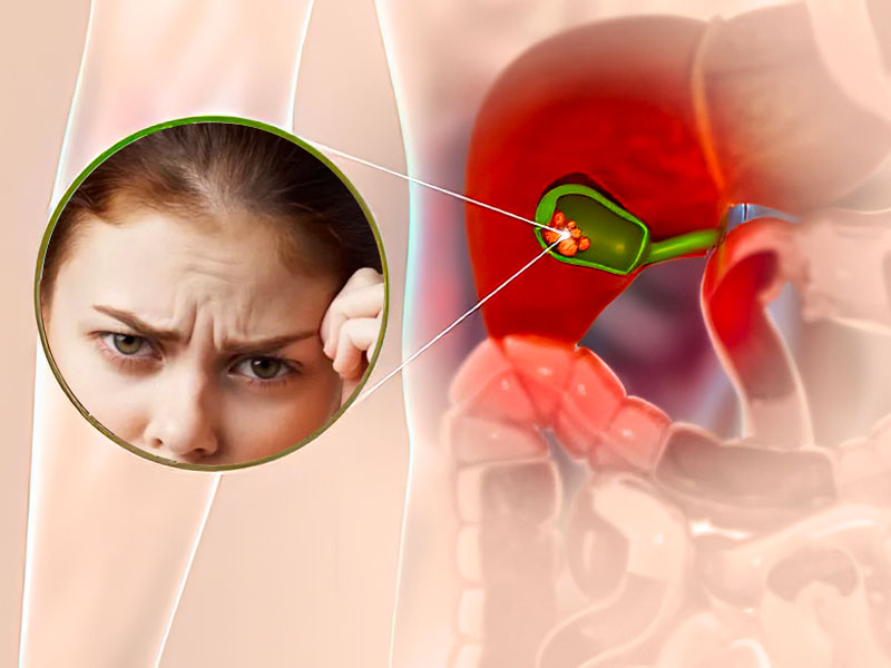 Dấu hiệu giúp phát hiện sỏi mật là nếp nhăn dọc giữa lông mày