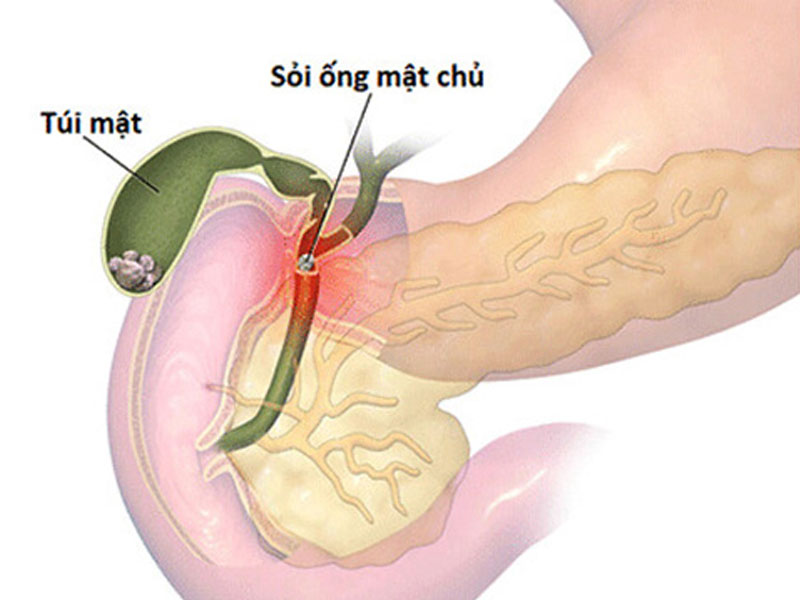 Đường ống mật chủ đóng vai trò rất quan trọng trong việc dẫn lưu dịch mật