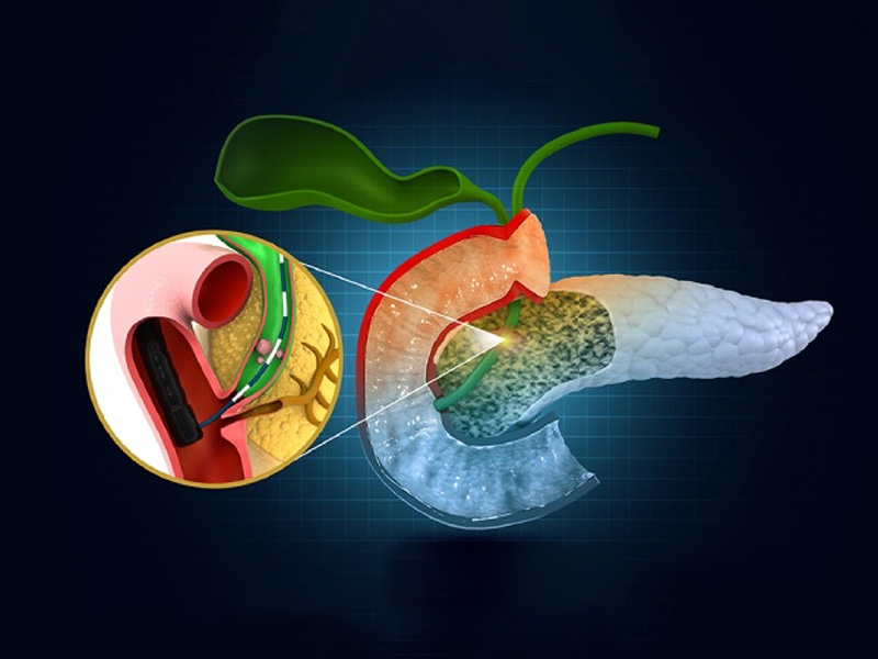 Điều trị sỏi ống mật chủ bằng nội khoa chỉ áp dụng cho sỏi có kích thước bé