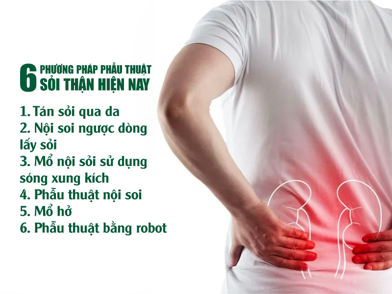 6 phương pháp phẫu thuật sỏi thận hiện nay