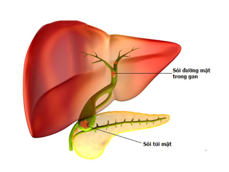 Sỏi mật trong gan dễ tái phát sau khi phẫu thuật
