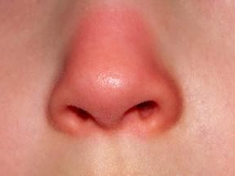 Mũi luôn đỏ là một dấu hiệu giúp phát hiện bệnh sỏi mật