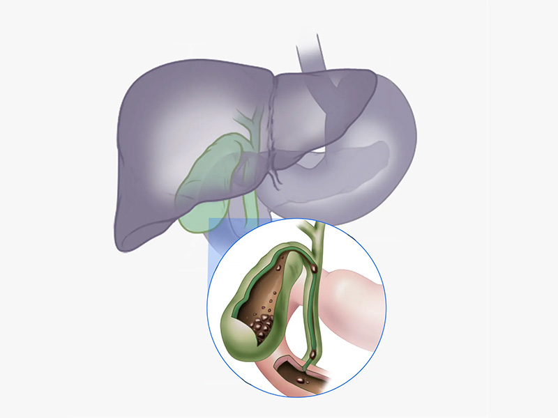 Sỏi là sự lắng đọng và kết tụ bởi nhiều yếu tố khác nhau