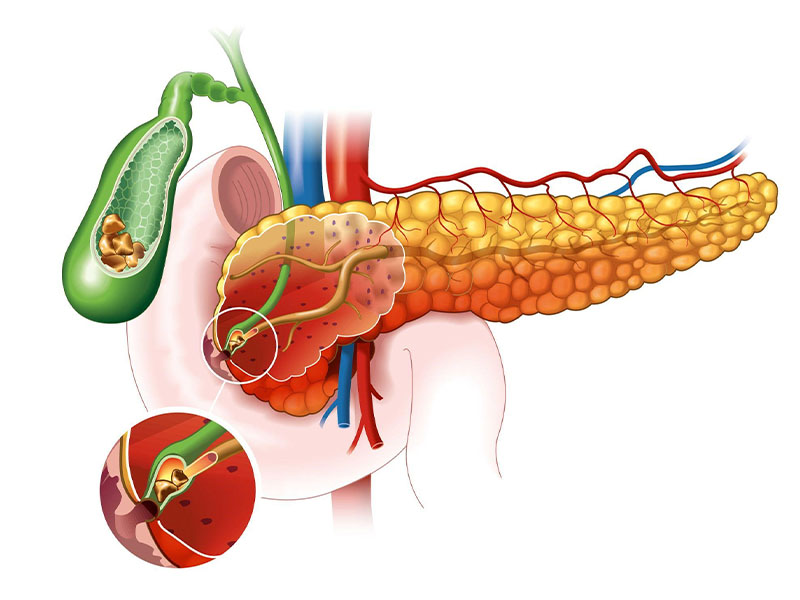 Sỏi mật gây biến chứng tắc mật dẫn đến tiêu hoá kém