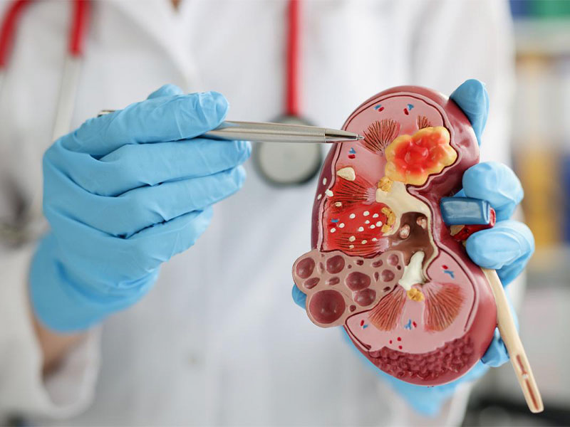 Điều trị sỏi thận tiểu buốt phụ thuộc vào mức độ viêm sẽ có phác đồ khác nhau