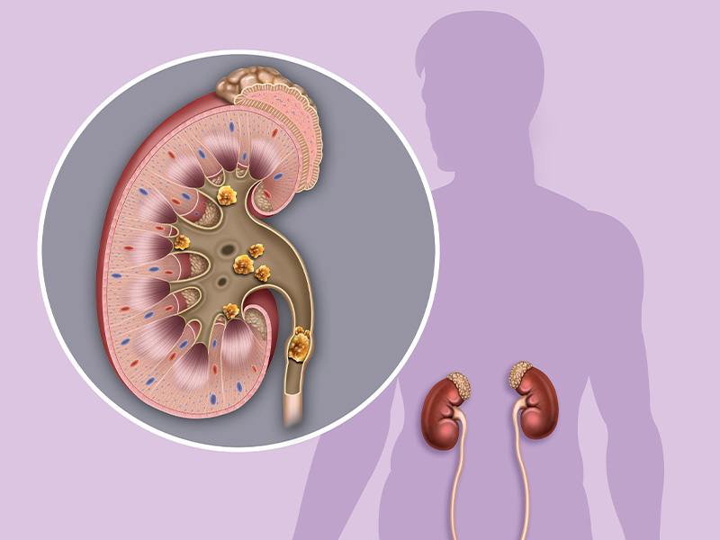 Sỏi thận là gì?