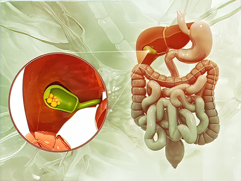 Sỏi mật ảnh hưởng đến chức năng của gan mật 