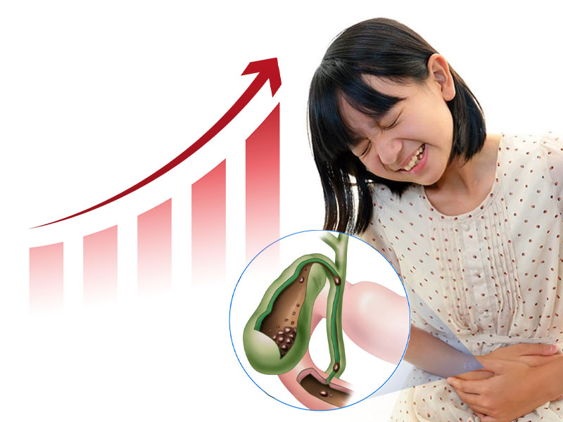 Trẻ em mắc sỏi mật đang có xu hướng tăng cao