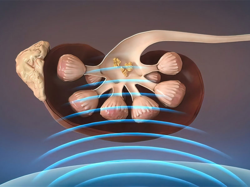 Sử dụng sóng xung kích qua da để đánh tan sỏi thận