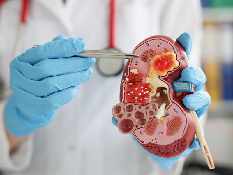 Mổ hở được áp dụng khi sỏi thận có kích thước lớn, dạng san hô, cạnh sắc nhọn ảnh hưởng nhiều đến chức năng của thận