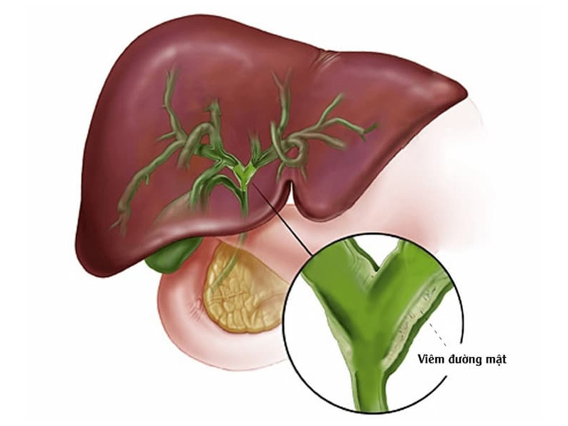 Viêm đường mật là gì?