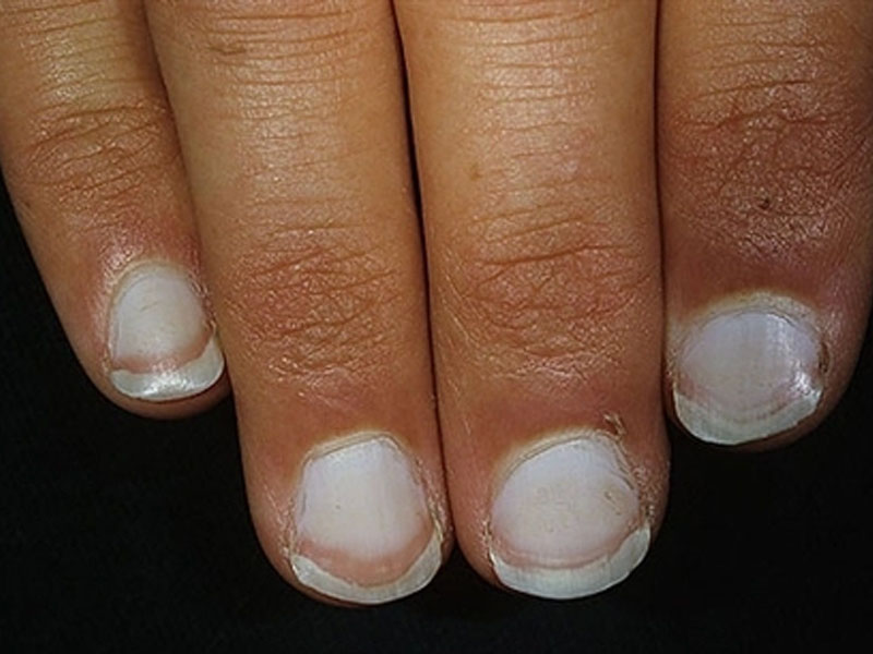 Móng tay trắng nhạt là biểu hiện của quá trình tích tụ quá nhiều cholesterol 