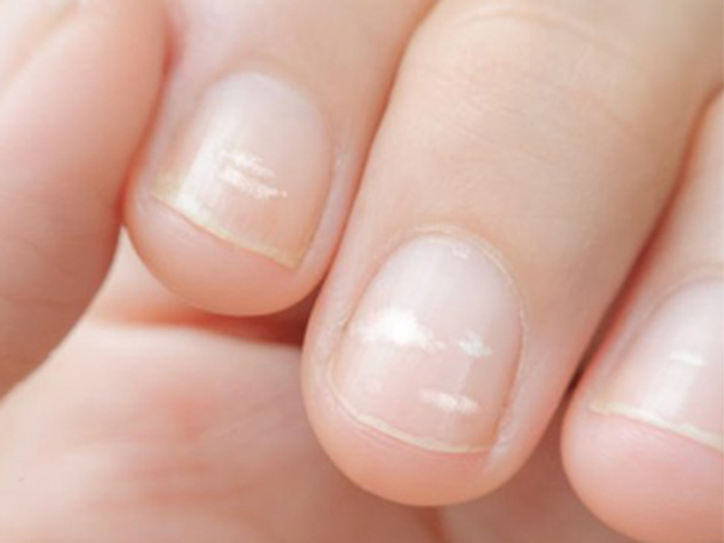 Nguy cơ mắc sỏi mật khi xuất hiện những chấm trắng trên móng tay 