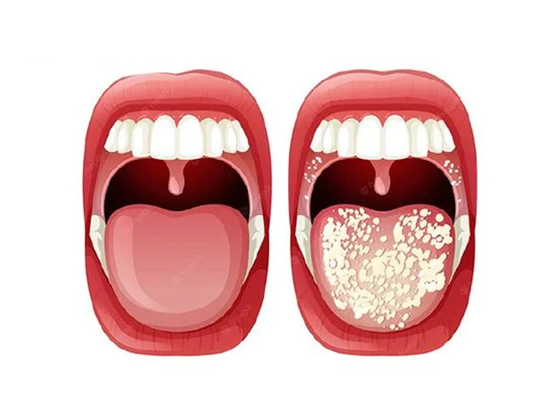 Lưỡi phủ màu vàng hoặc trắng đặc biệt ở phía trong tăng nguy cơ mắc sỏi mật