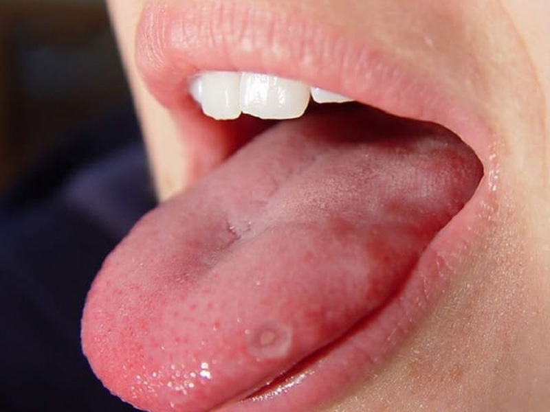 Mụn nhọt mọc trên lưỡi chứng tỏ hệ vi sinh đường ruột đang mất cân bằng