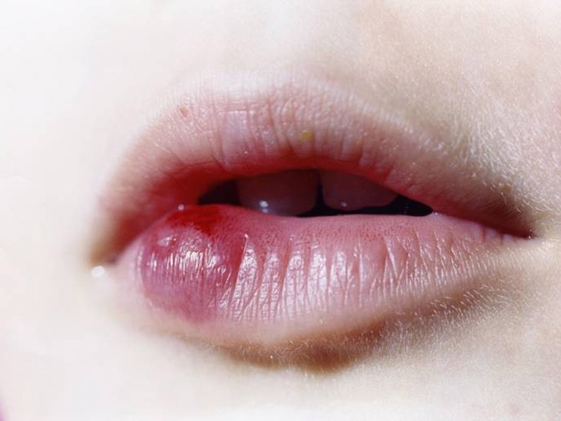 Môi sưng hoặc phình to chứng tỏ đường ruột đang bất ổn
