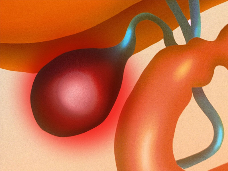 Biến chứng của sỏi đường mật gây ra là rất nguy hiểm